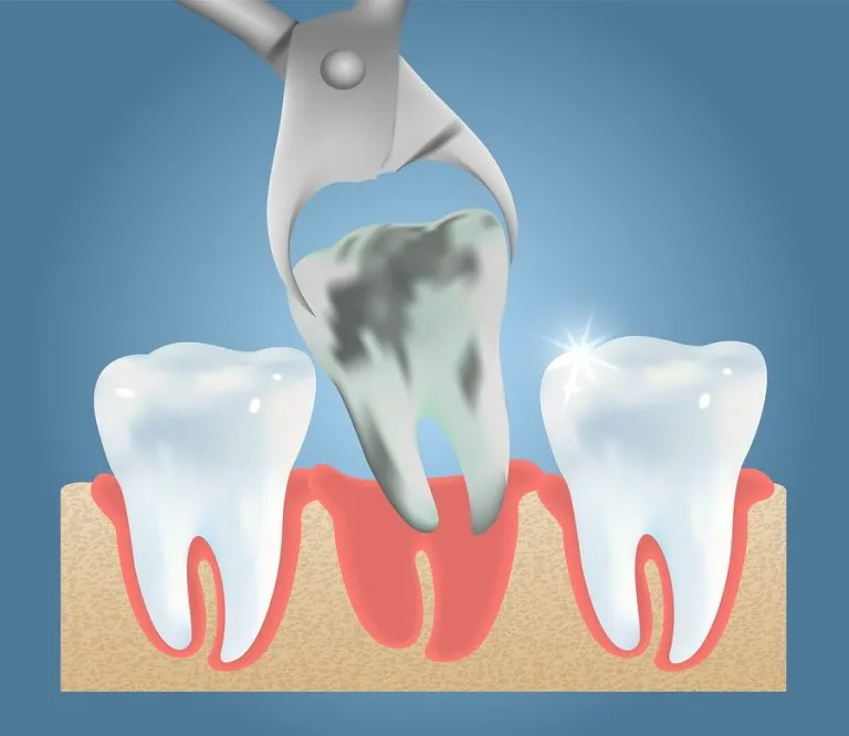 When Is a Tooth Extraction Necessary?