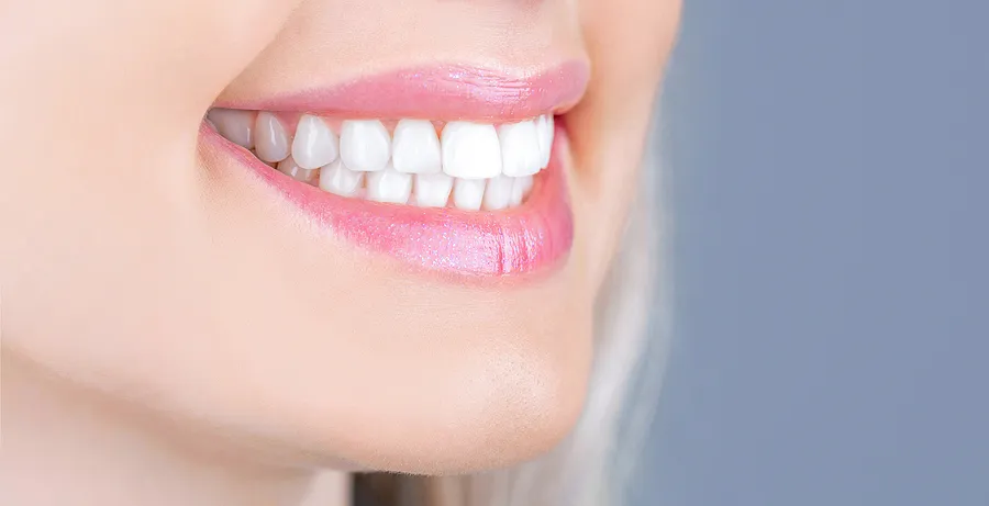 The Ultimate Guide to Teeth Whitening in Salt Lake City, UT: Achieve a Brighter Smile