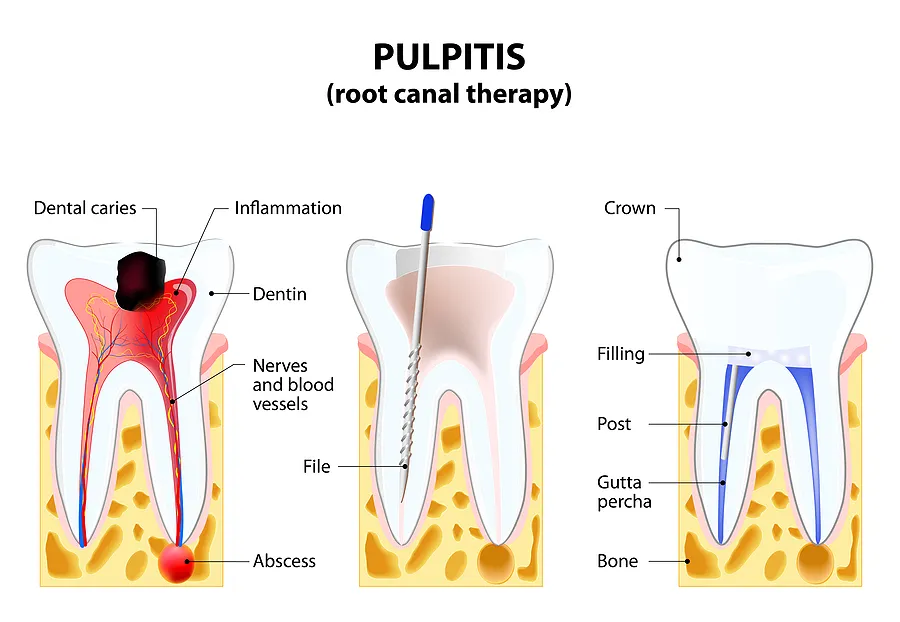 Understanding Root Canal Therapy: A Guide to Restoring Your Oral Health