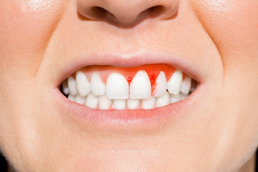 Periodontal Disease – Diagnosis and Treatment
