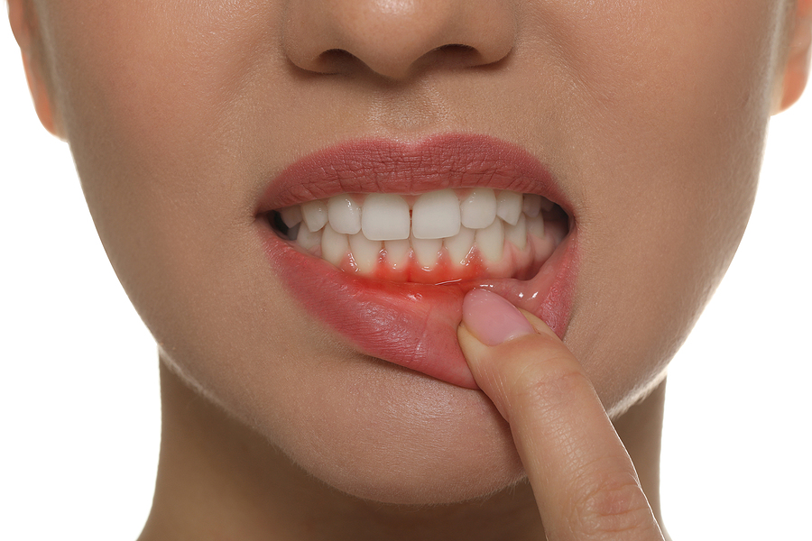 4 Common Symptoms of Gum Disease