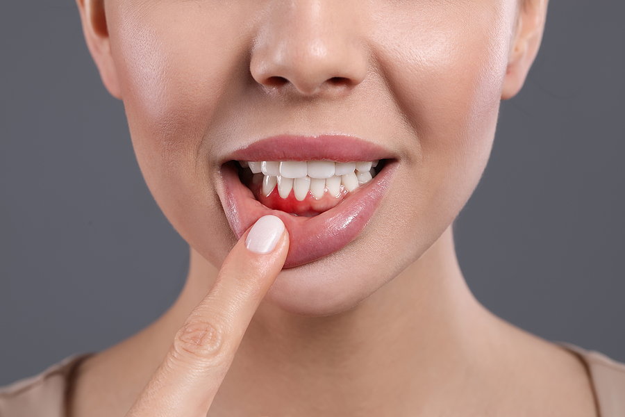What Causes Gum Disease?