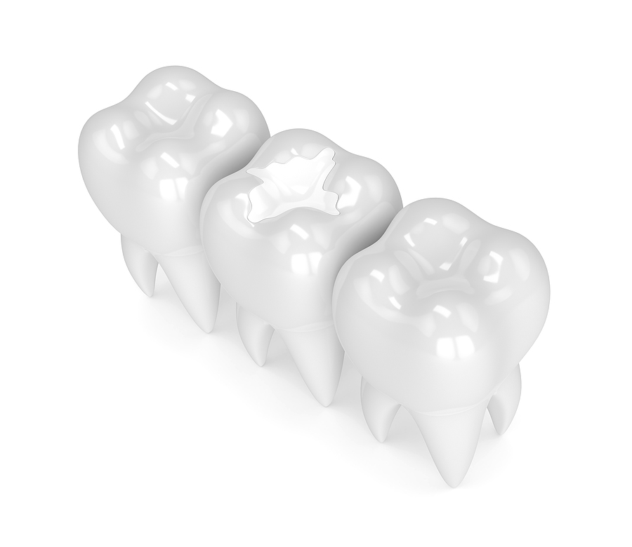 Enhancing Your Smile with White Fillings in Salt Lake City, UT